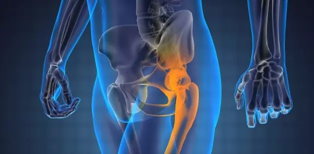 Kalça Osteoartriti Nedir?