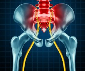 Piriformis Sendromu