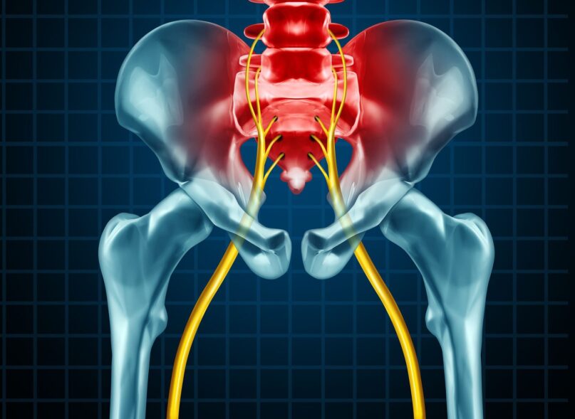 Piriformis Sendromu